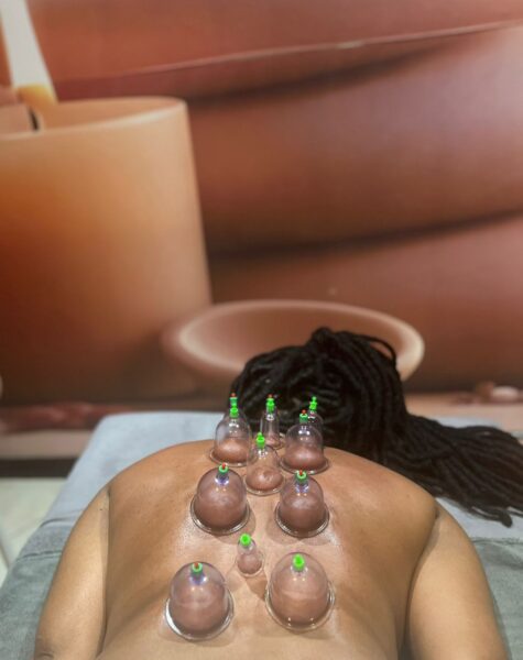 Woman recieving cupping therapy